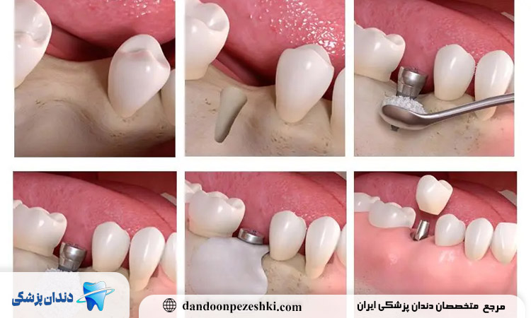 بهترین دکتر ایمپلنت در پونک