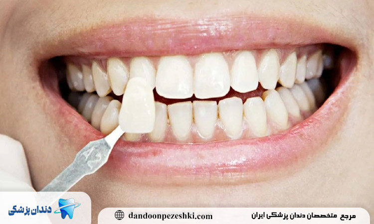 کندن روکش دندان در خانه