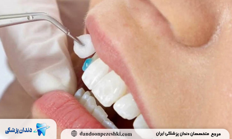 بهترین چسب مخصوص روکش دندان