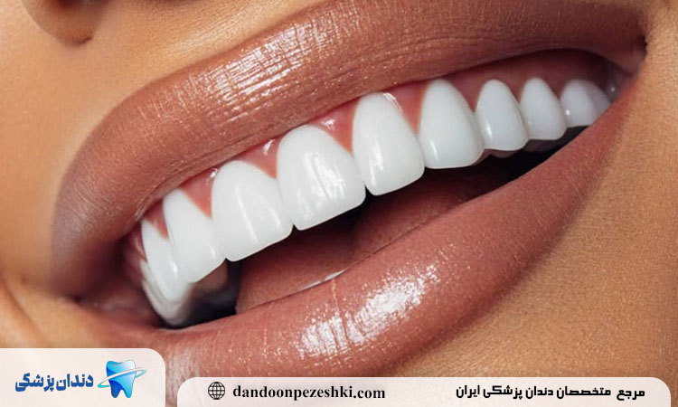 کامپوزیت دندان چیست