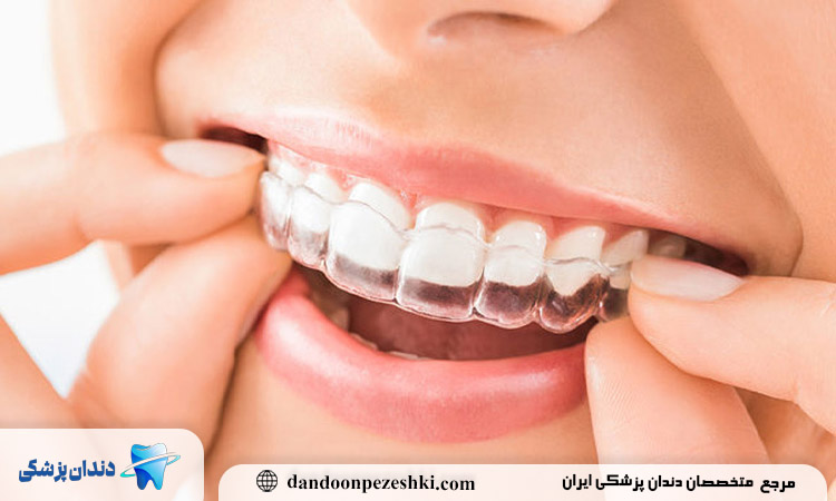 ارتودنسی شفاف انتخاب افرادی که نمی خواهند کسی متوجه درمانشان شود