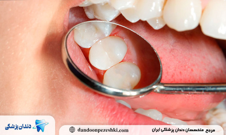 آیا ترمیم دندان نیاز به بی حسی دارد؟