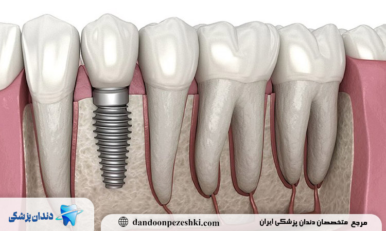 ایمپلنت در فرمانیه