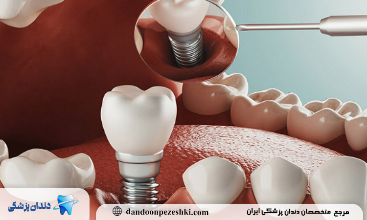 خطرات ایمپلنت دندان