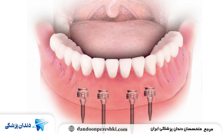 ایمپلنت دندان