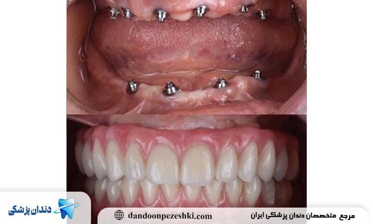 ایمپلنت دیجیتال دندان