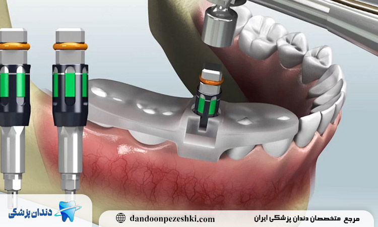 ایمپلنت دیجیتال