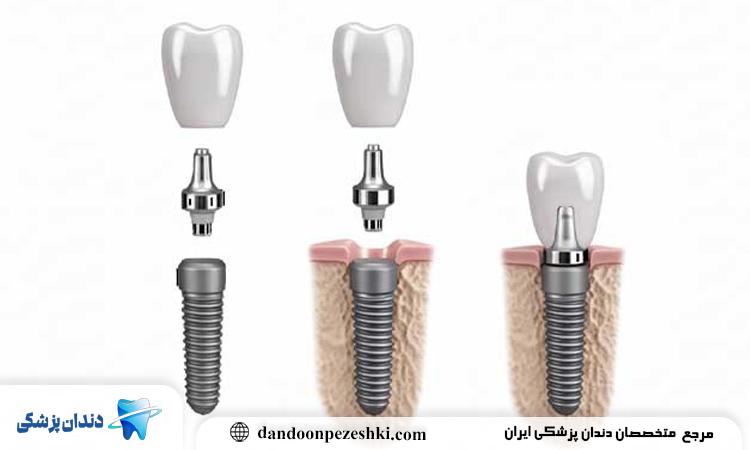 ایمپلنت سنتی