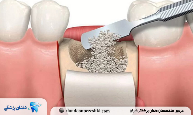 ایمپلنت پودری، نجات بخش بیماران با کمبود استخوان