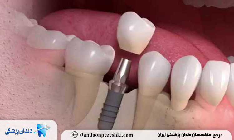 ایمپلنت یک مرحله ای