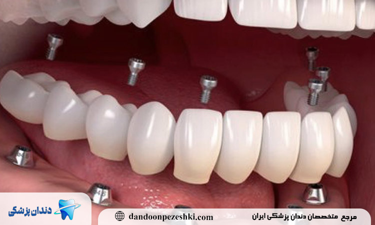 کاشت دندان بدون جراحی