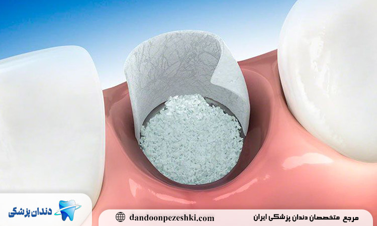 دکتر برای ایمپلنت پودری