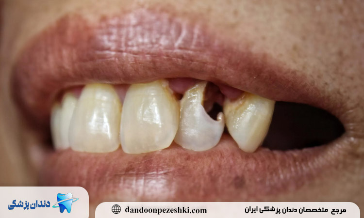 خرابی دندان از ریشه