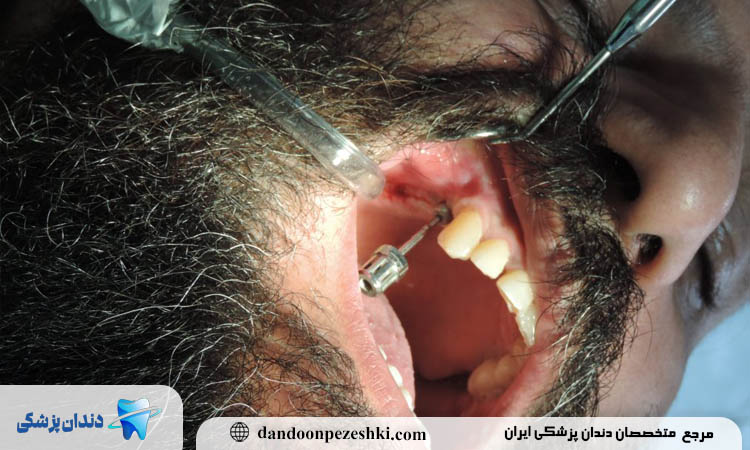 دکتر ایمپلنت در فرمانیه