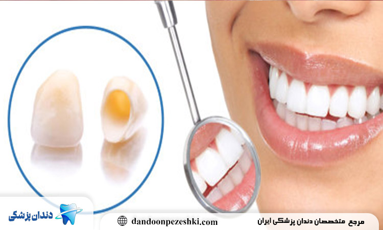 عمر روکش دندان