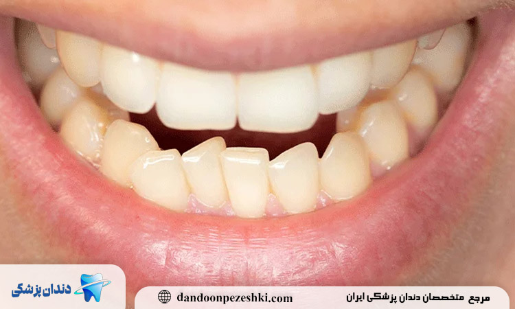 علت کج شدن دندان ها
