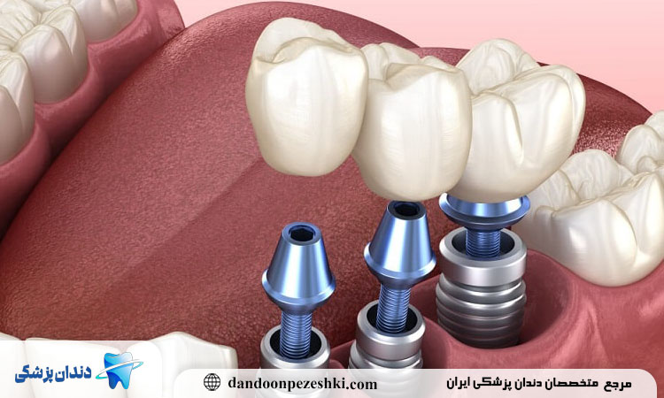 مزایا کاشت دندان بدون جراحی