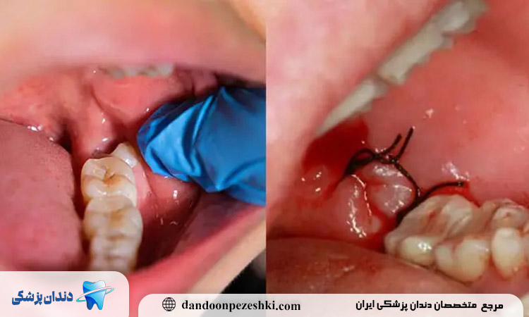 عوارض کشیدن دندان عقل پایین