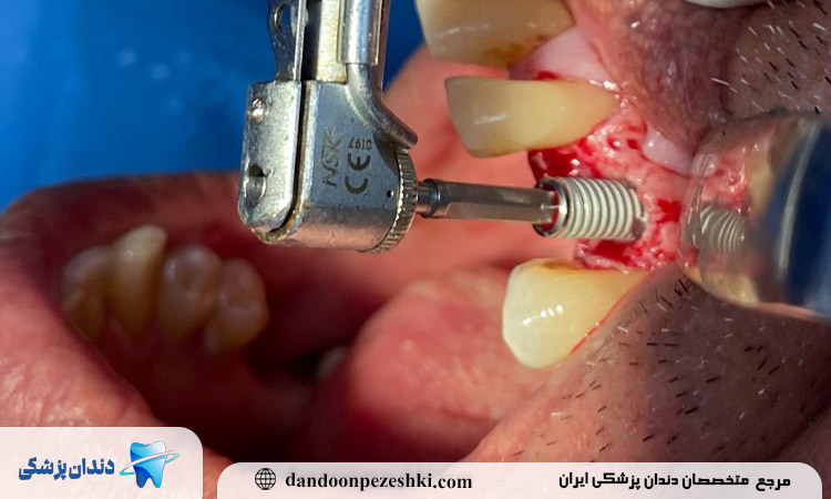 معایب کاشت دندان بدون جراحی