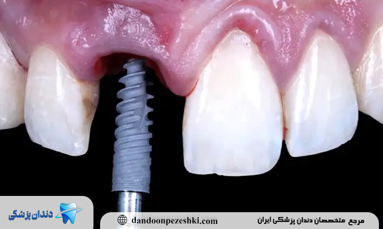 ایمپلنت دندان یک مرحله ای