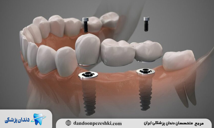 ایمپلنت دیجیتال 