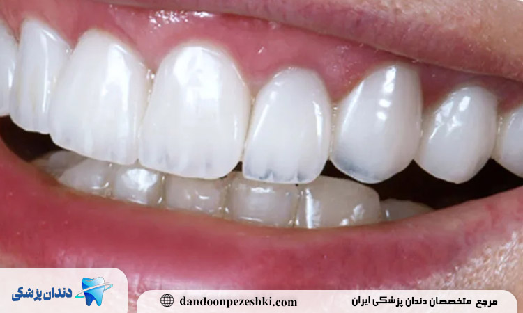 معایب کامپوزیت دندان