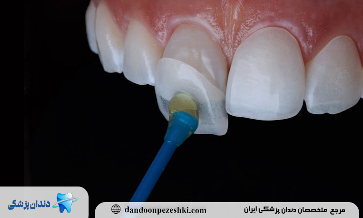 معایب کامپوزیت