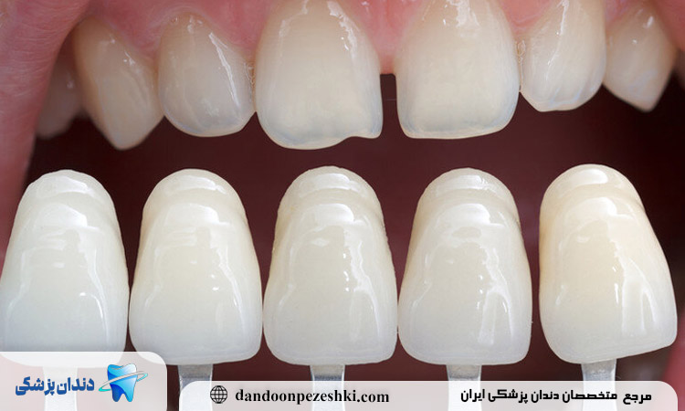کامپوزیت دندان