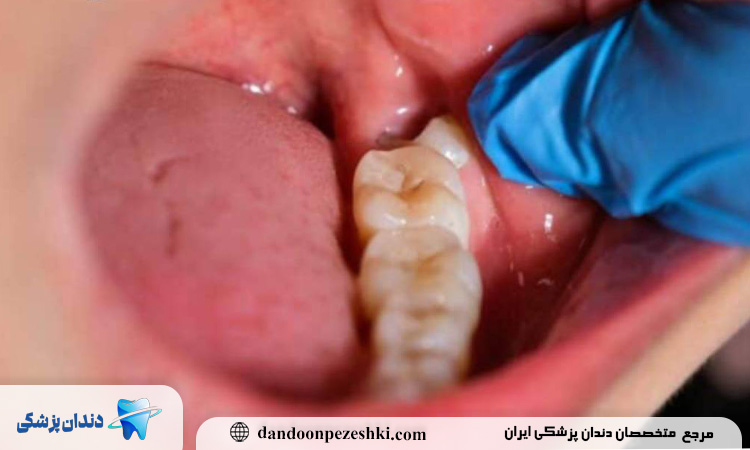 نتیجه درمان دندان عقل