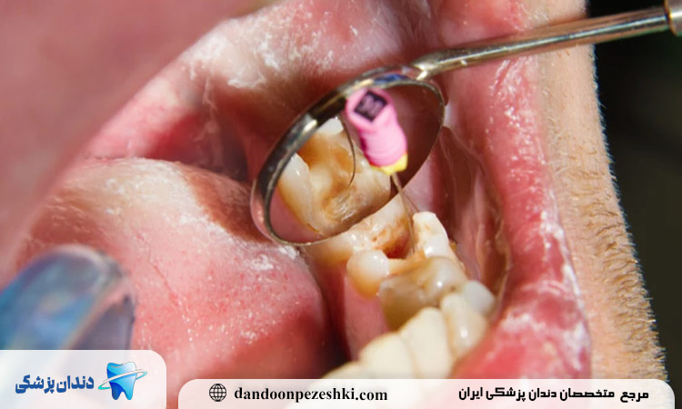 درمان پوسیدگی دندان