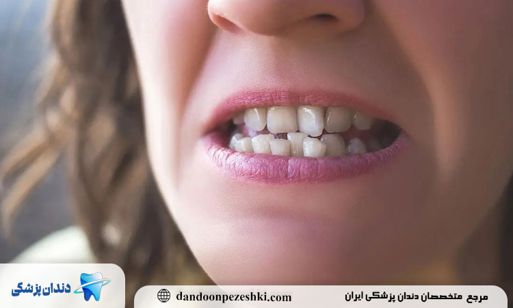 نقش فک در کجی دندان