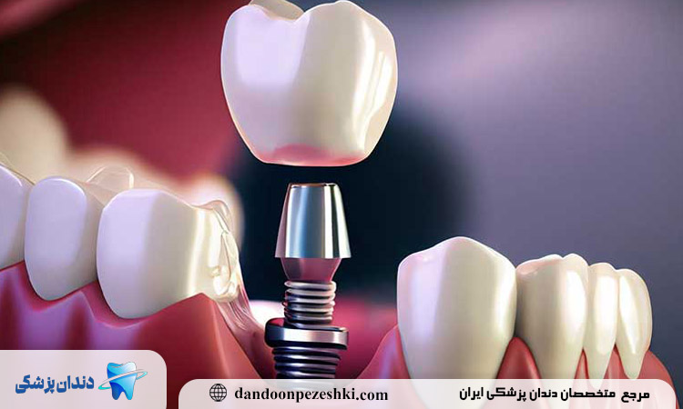 انتخاب دکتر ایمپلنت فرمانیه