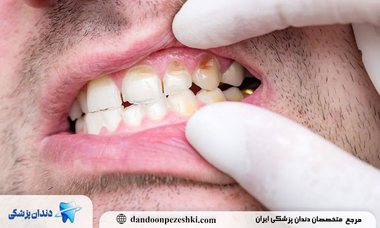 پوسیدگی دندان