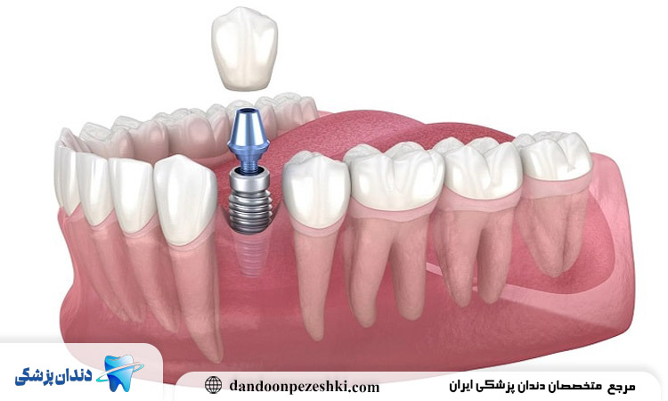 کاشت دندان بدون جراحی