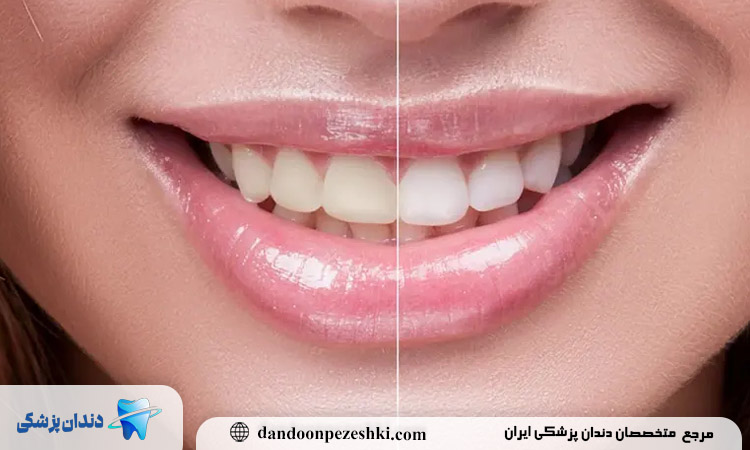 کامپوزیت دندان