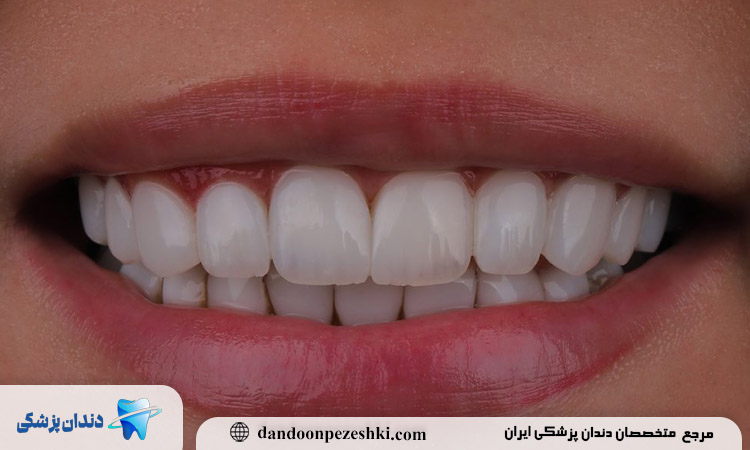 متخصص زیبایی کامپوزیت دندان