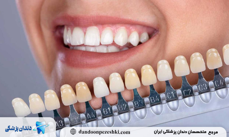 کامپوزیت روی دندان روکش شده