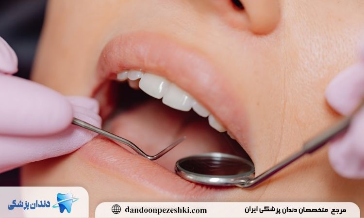 چه زمانی به روکش احتیاج داریم؟