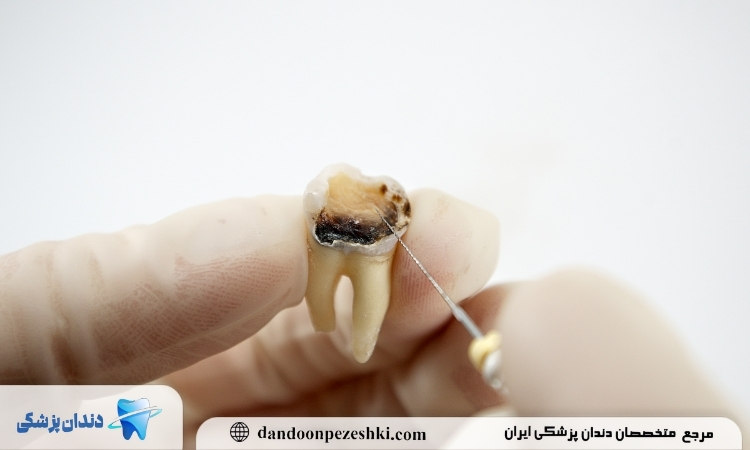 ارتباط بین پوسیدگی دندان و بوی بد دهان