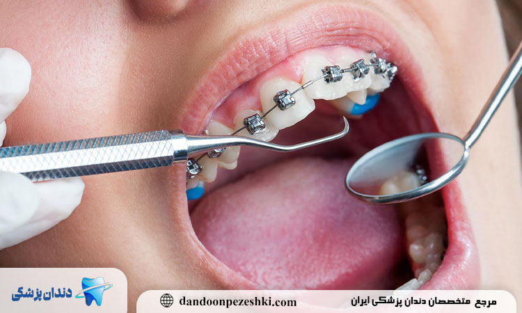 ارتودنسی دندان