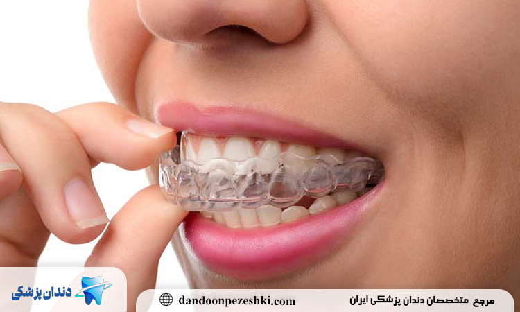 ارتودنسی سریع چیست؟