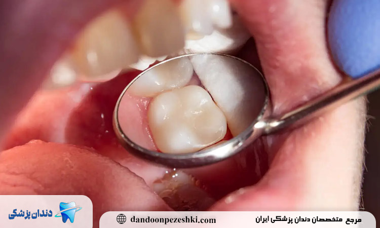 پوسیدگی دندان