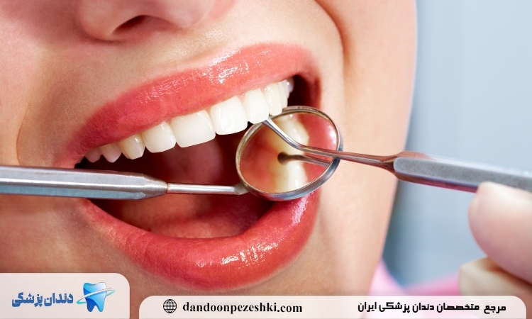 بلیچینگ دندان