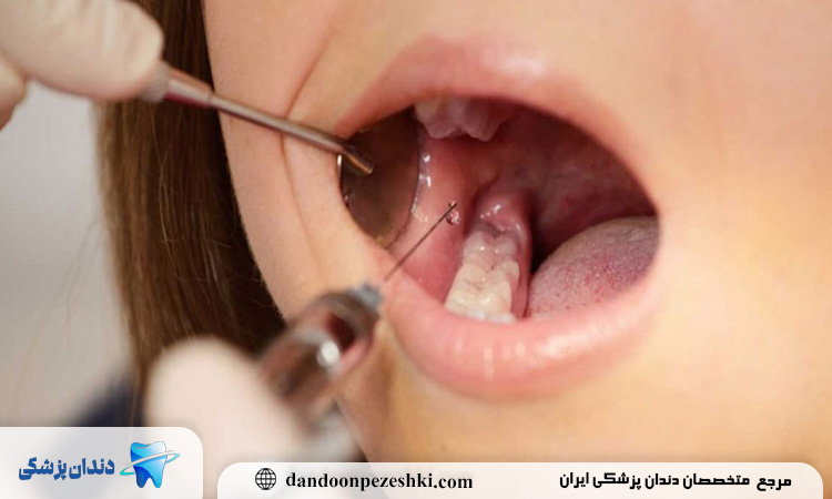 استفاده از آمپول بی حسی دندان