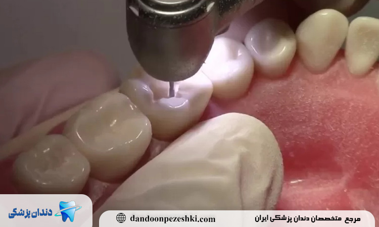 ترمیم دندان