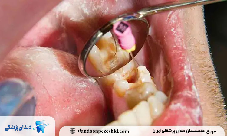 دندان درد بعد از عصب کشی
