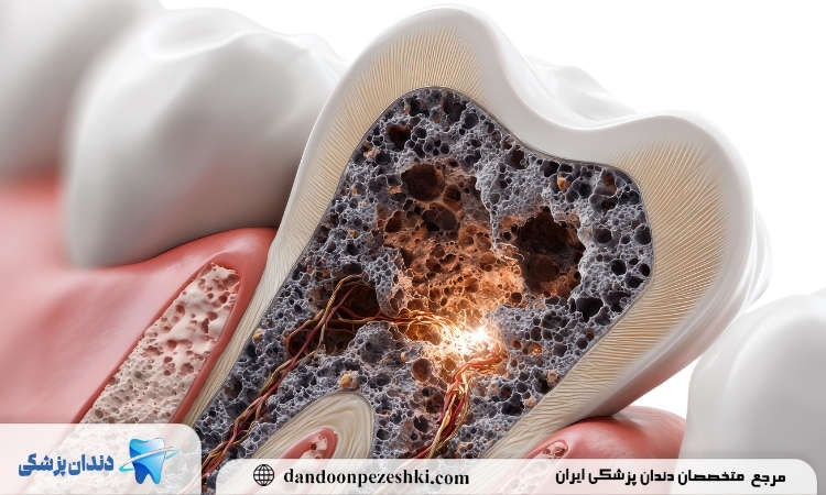 پوسیدگی دندان