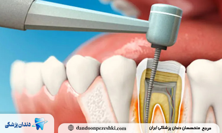 علت شکستگی ریشه دندان
