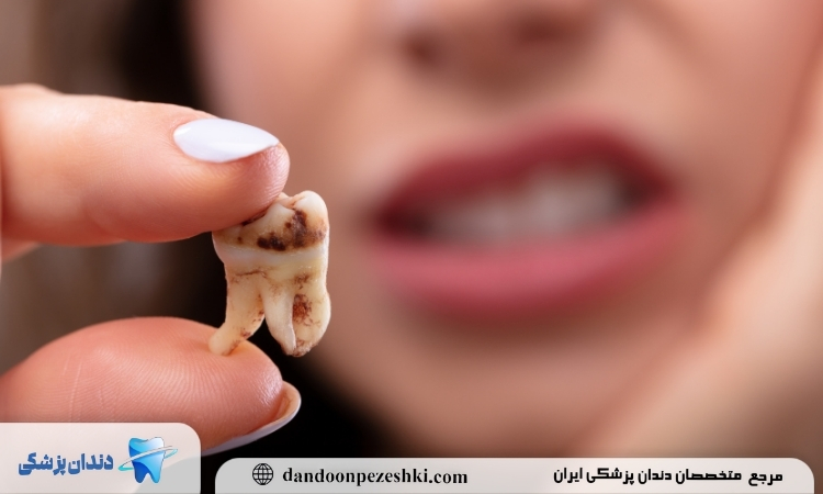 پوسیدگی دندان