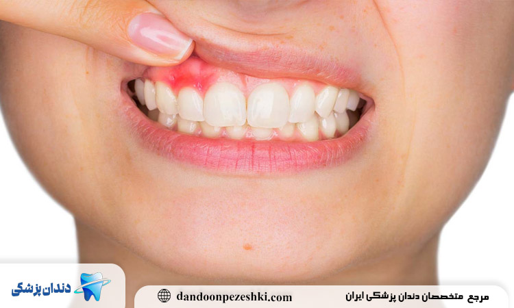 دندان مصنوعی و التهاب لثه